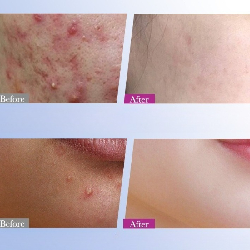 7/10/14 szt. Kolorowe plasterk – Skincare Qv recenzja i cena